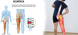 sciatica relief